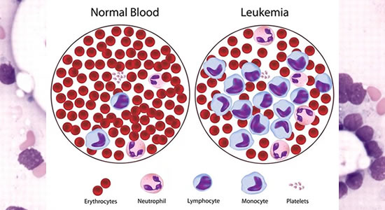 Leukemia2