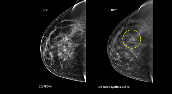 U.S. Study Recommend More Frequent Mammogram Screening