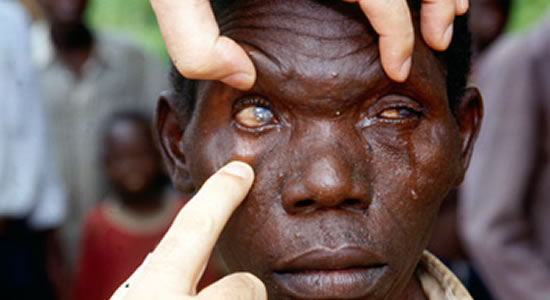 River Blindness Is Successfully Controlled In Africa -  WHO
